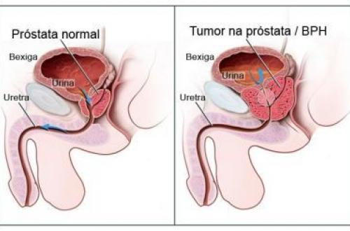 Exame de Próstata